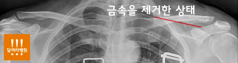 견봉쇄골 관절 탈구 수술 후 금속판을 제거한 뒤의 X-ray