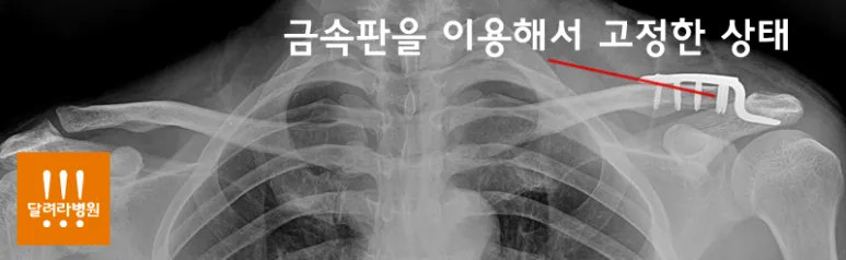 견봉쇄골 관절 탈구 수술 후 X-ray. 오구쇄골 간격이 정상으로 회복되고 고정된 모습