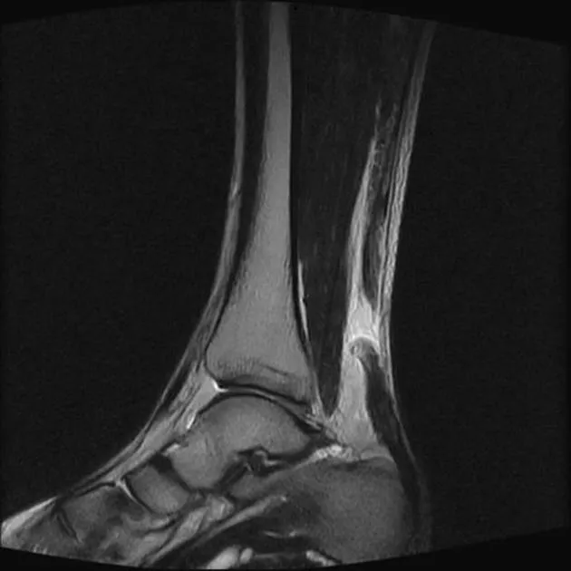 아킬레스건 파열 MRI. 발목 뒤쪽 아킬레스건이 연속성을 잃고 파열된 부위가 확인된다