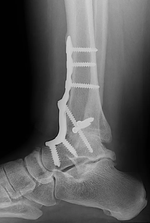 발목 유합술 후 옆면 X-ray. 금속판과 나사로 정강이뼈와 발목뼈를 고정한 모습
