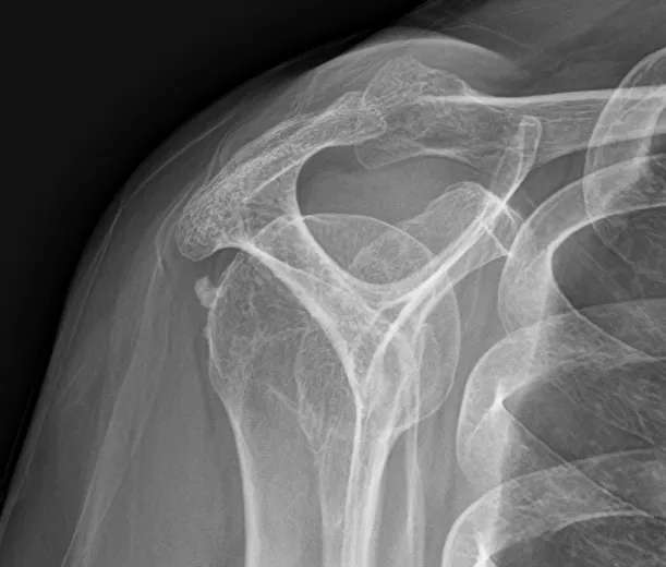 석회성건염 어깨 X-ray. 상완골 머리 뒤쪽에 작은 석회가 보이는 모습