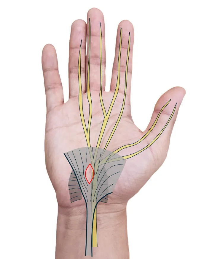 손목터널 유리술(carpal tunnel release) 모식도. 손목 통로를 덮은 가로손목인대(빨간 선)를 절개해 눌린 정중신경의 압박을 푸는 부위를 보여준다