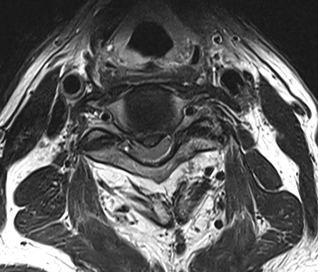 경추 디스크 MRI. 튀어나온 디스크가 척수를 누르는 가로 단면