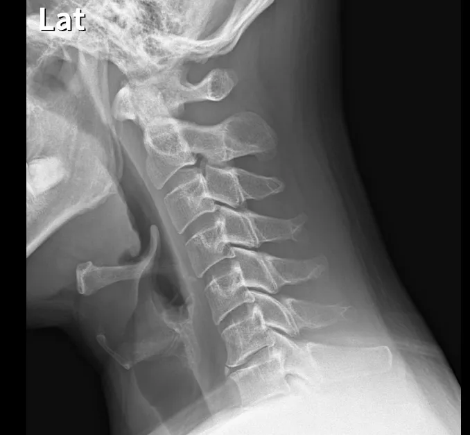 경추 X-ray. 목뼈의 정상적인 앞굽음(C자 커브)이 사라지고 일자로 곧게 서 있는 일자목 소견
