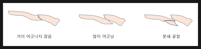 쇄골 골절의 여러 형태