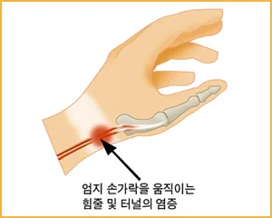 드퀘르뱅 건초염 모식도. 엄지와 연결된 손목 힘줄과 그 통로에 염증이 생긴 모습