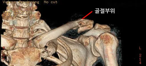 원위(바깥쪽) 쇄골 골절 3차원 CT, 다른 각도에서 본 골절 부위