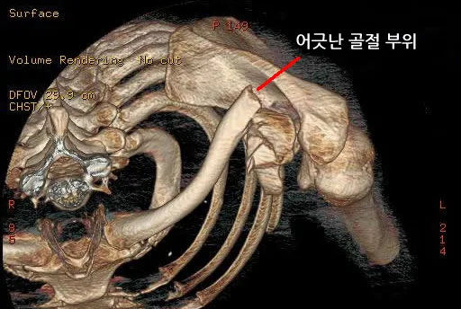 원위(바깥쪽) 쇄골 골절 3차원 CT, 어긋난 골절 부위가 표시되어 있음
