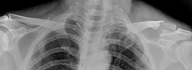 원위(바깥쪽) 쇄골 골절 수술 전 x-ray, 쇄골 바깥쪽이 어긋나 있음