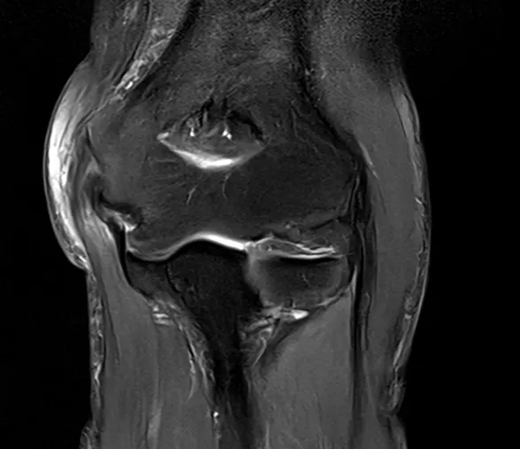 골프엘보(내측상과염) MRI. 팔꿈치 안쪽 뼈에 붙는 힘줄이 하얗게 변한 모습