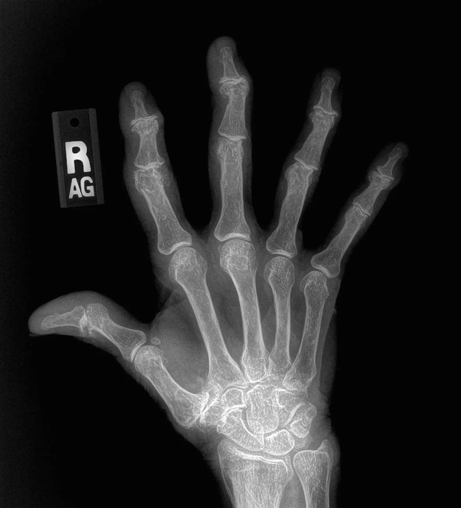 수부 관절염 X-ray. 엄지손가락 뿌리 관절(CMC)을 포함한 여러 손가락 관절의 간격이 좁아진 모습이 보인다