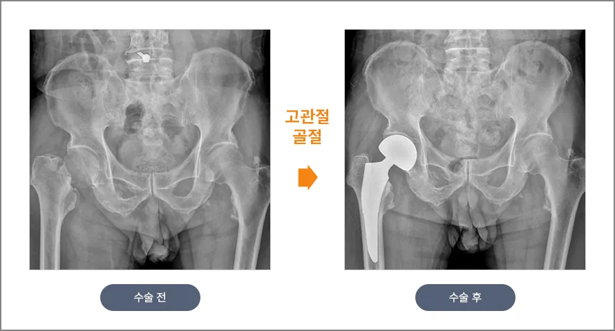 고관절 골절 수술 전후 X-ray