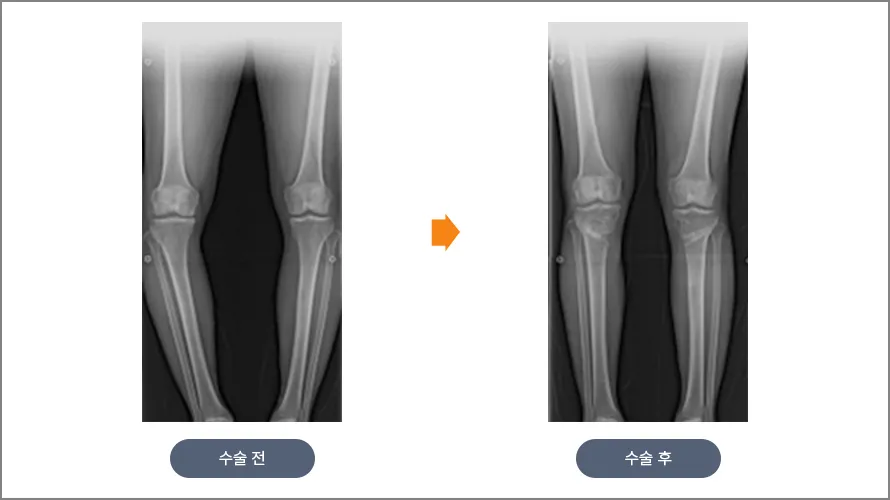 근위경골 절골술 전후 다리 정렬(축) 비교