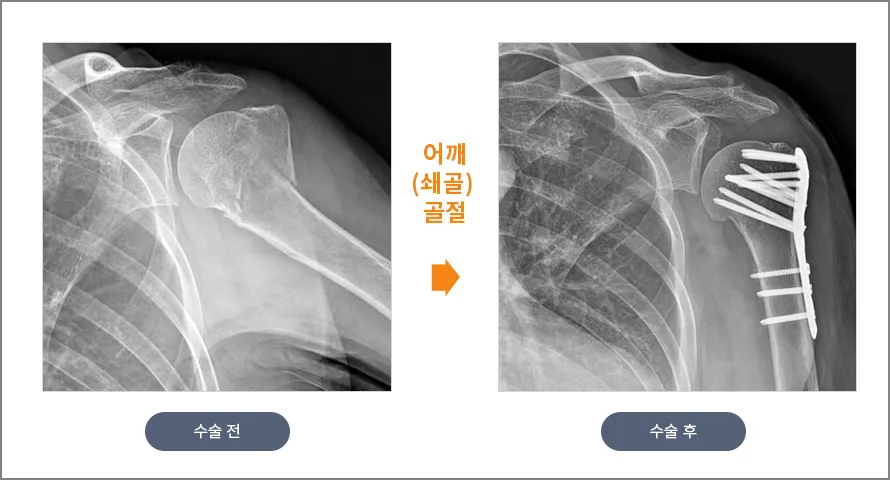 상완골 골절 수술 전후 X-ray