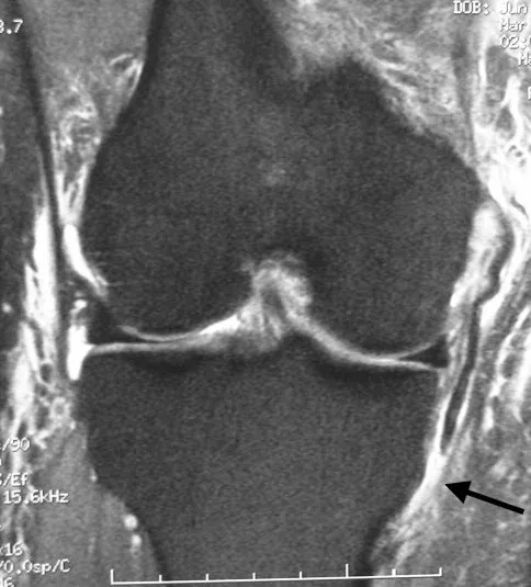 무릎 내측측부인대(MCL) 파열 MRI. 화살표가 가리키는 인대 부위에 손상과 주변 부종이 보인다