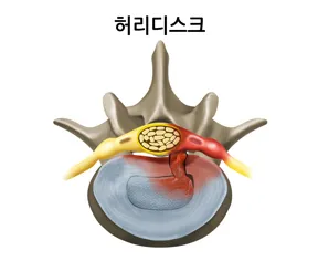 허리디스크 모식도. 터진 수핵이 신경뿌리를 누르는 구조