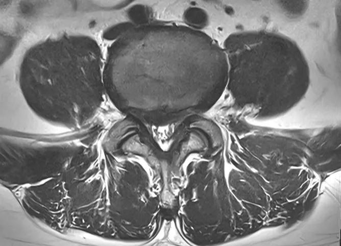 허리디스크 MRI 가로 단면. 튀어나온 디스크가 신경을 누르는 소견