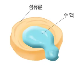 허리디스크 수핵 파열 모식도. 섬유륜의 틈으로 수핵이 새어 나와 신경을 자극