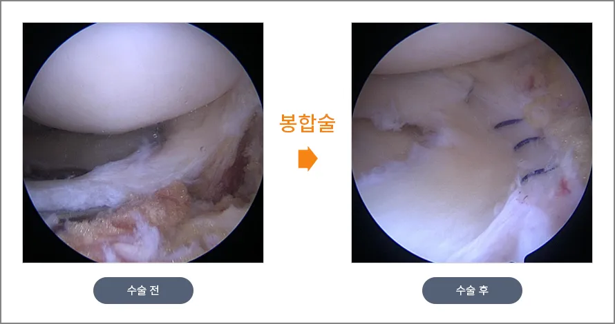 무릎 관절경으로 파열된 반월상연골판을 봉합하는 사진