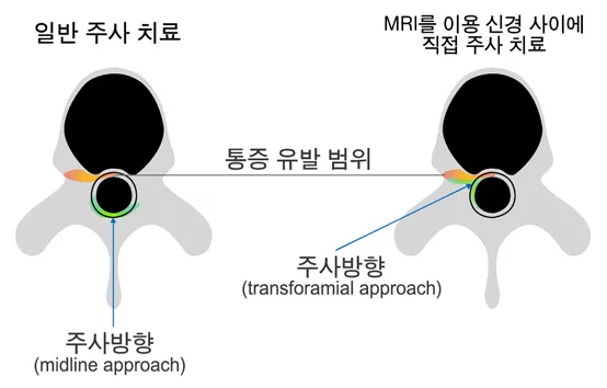 경막외(midline) 방식과 추간공(transforaminal) 방식 신경주사 비교 모식도