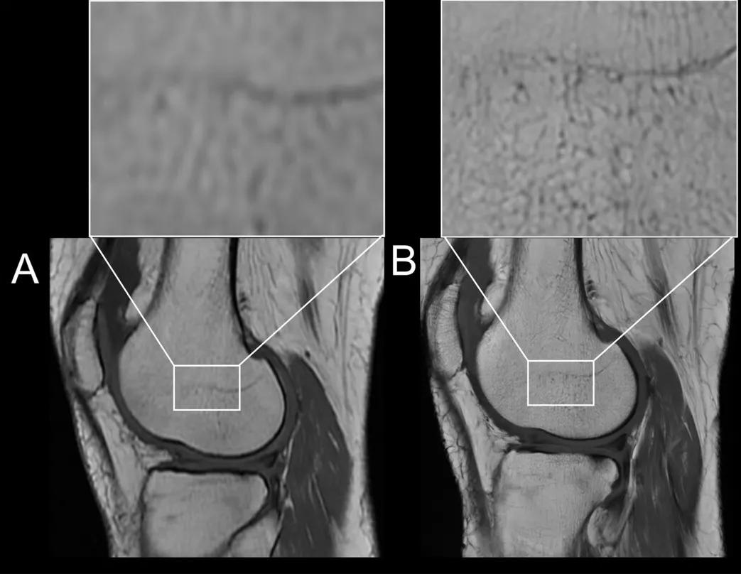 테슬라 세기에 따른 MRI 영상 질 비교. A는 낮은 자기장, B는 3.0T로 촬영한 무릎 관절 영상이며 확대한 부위에서 해상도 차이가 뚜렷하다
