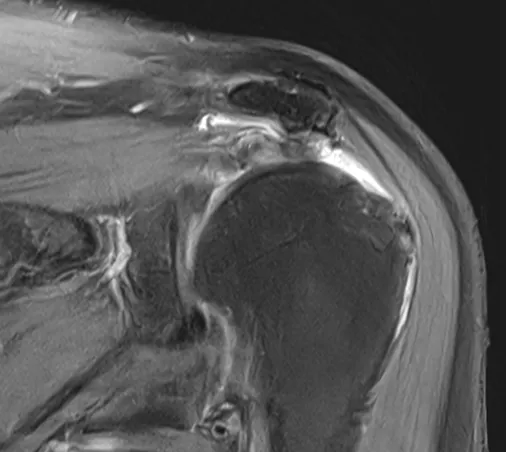 회전근개파열 MRI. 파열된 힘줄이 안쪽으로 말려 들어간 모습