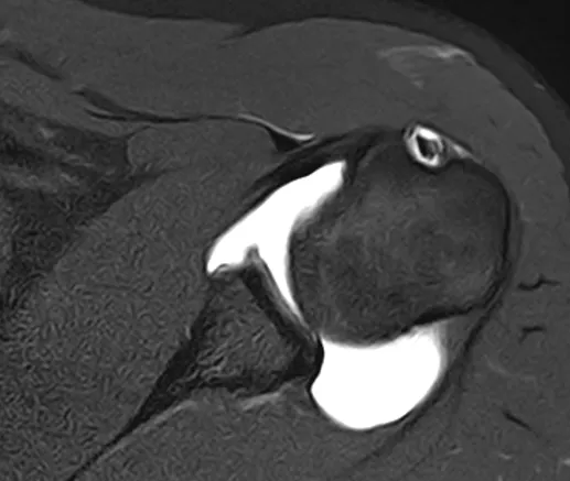 어깨 탈구 MRI. 관절와 앞쪽에 있어야 할 관절와순이 파열되어 보이지 않는 방카르트 병변