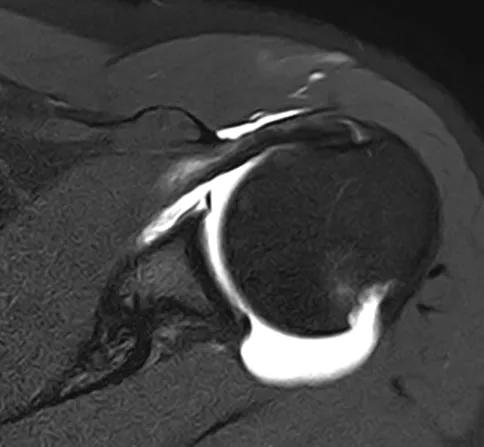 어깨 탈구 MRI. 위팔뼈 머리 뒤쪽이 움푹 들어간 힐-삭스 병변