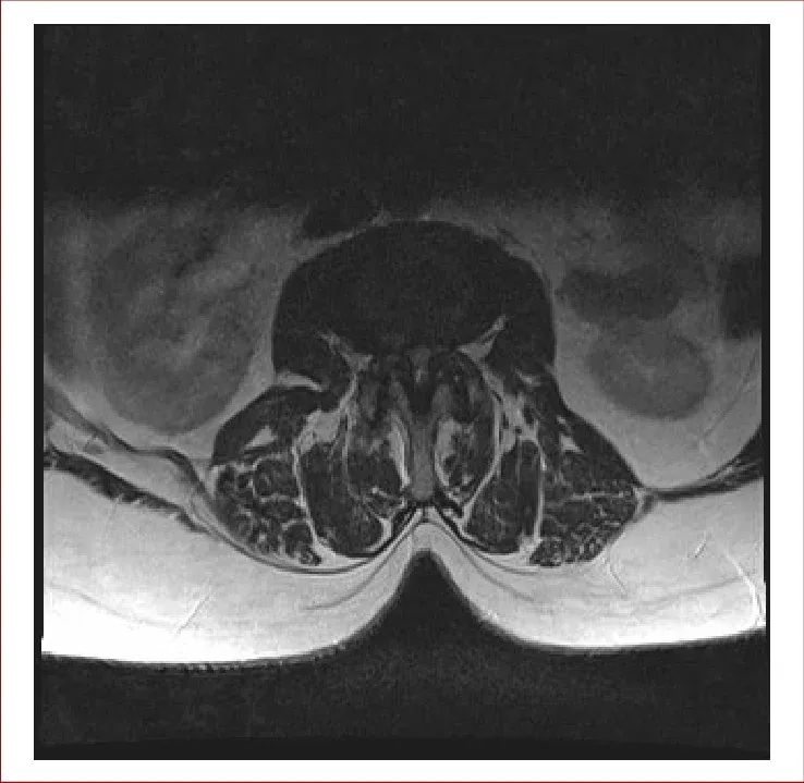 척추관협착증 MRI. 신경 통로가 심하게 좁아져 있는 소견