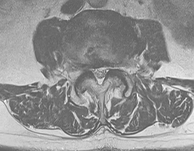척추관협착증 MRI. 신경이 지나가는 통로가 좁아진 모습