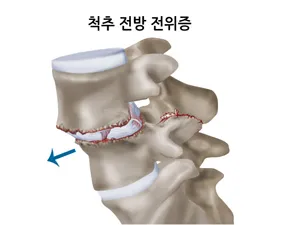 척추전방전위증 모식도. 위 척추뼈가 아래 뼈보다 앞으로 밀려난 구조