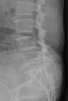 척추전방전위증 X-ray. 위 척추뼈가 아래 뼈보다 앞으로 밀려나 계단 모양으로 어긋난 소견