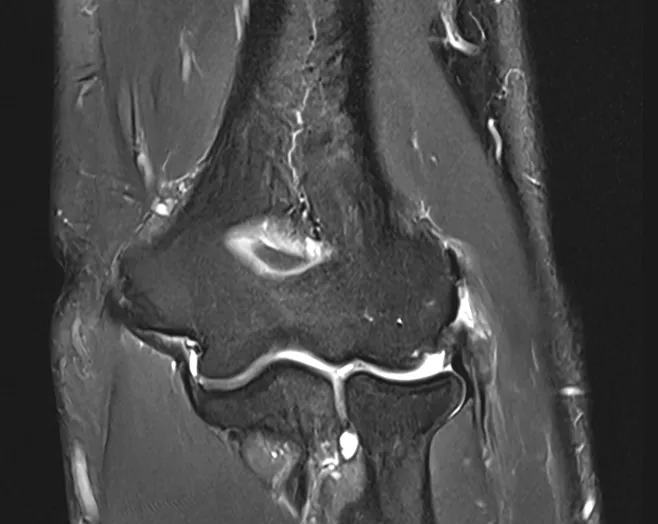 테니스엘보(외측상과염) MRI. 팔꿈치 바깥쪽 뼈에 붙는 힘줄이 파열되어 하얗게 된 모습