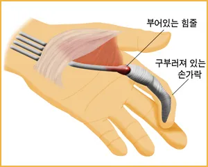 방아쇠수지 모식도. 손가락을 굽히는 힘줄과 그 통로에 염증이 생겨 걸림이 발생하는 구조
