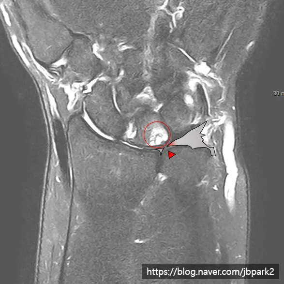 척골충돌증후군 MRI. 척골과 맞닿는 손목뼈에 부종과 낭종이 보이는 모습