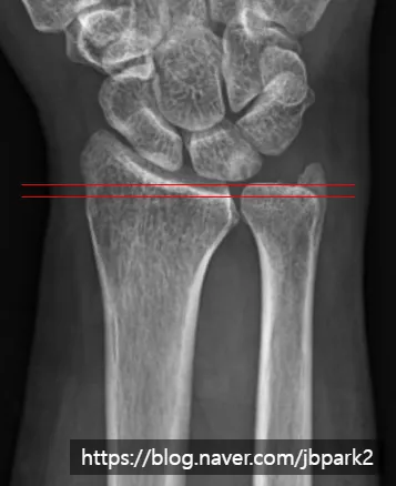척골충돌증후군 X-ray. 척골이 요골보다 상대적으로 길게 보이는 양성 척골 변이