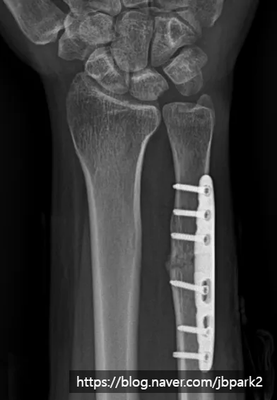 척골 단축 절골술 후 X-ray. 척골 간부를 짧게 자르고 금속판으로 고정해 척골 길이가 정상화된 모습