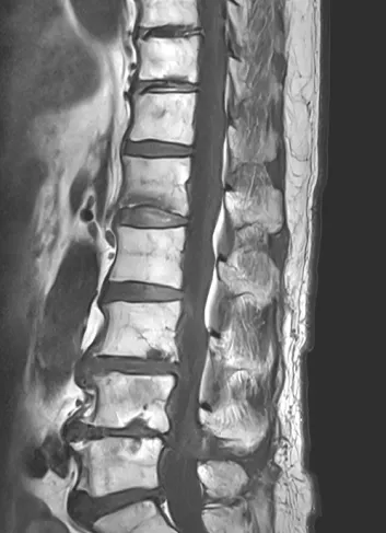 척추 압박골절 MRI. 골절된 뼈가 주저앉고 골수 부종으로 검게 보이는 급성 소견