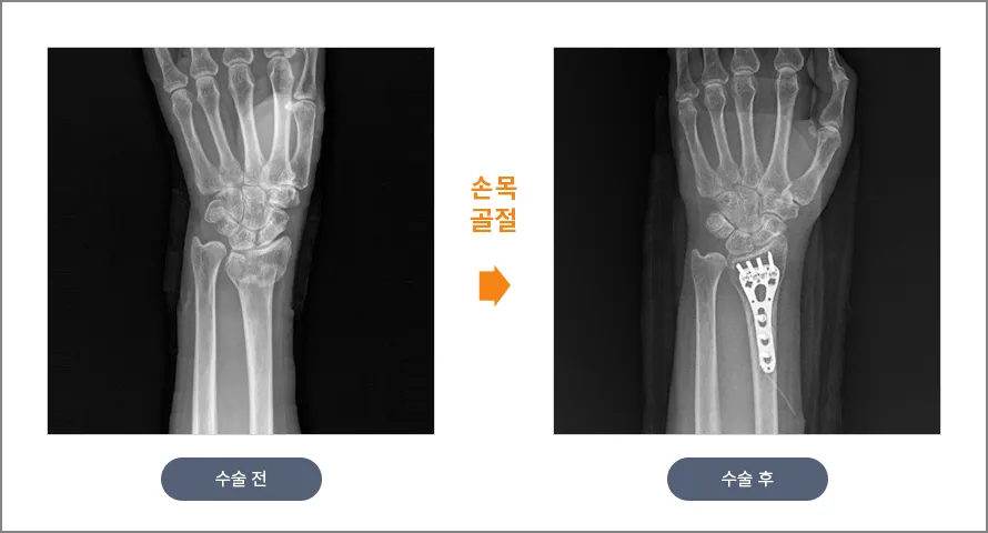 손목 골절 수술 전후 X-ray
